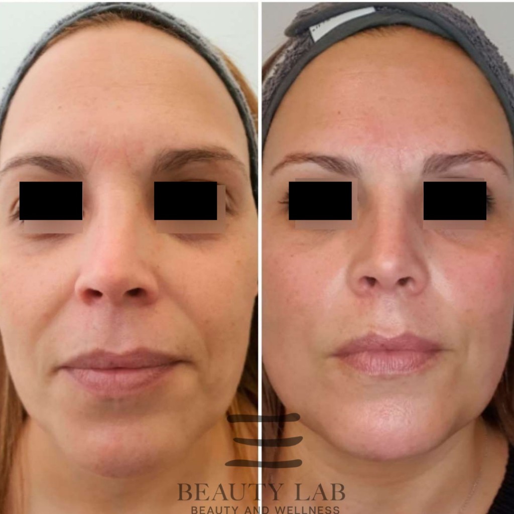 Risultato Skin Perfect 2