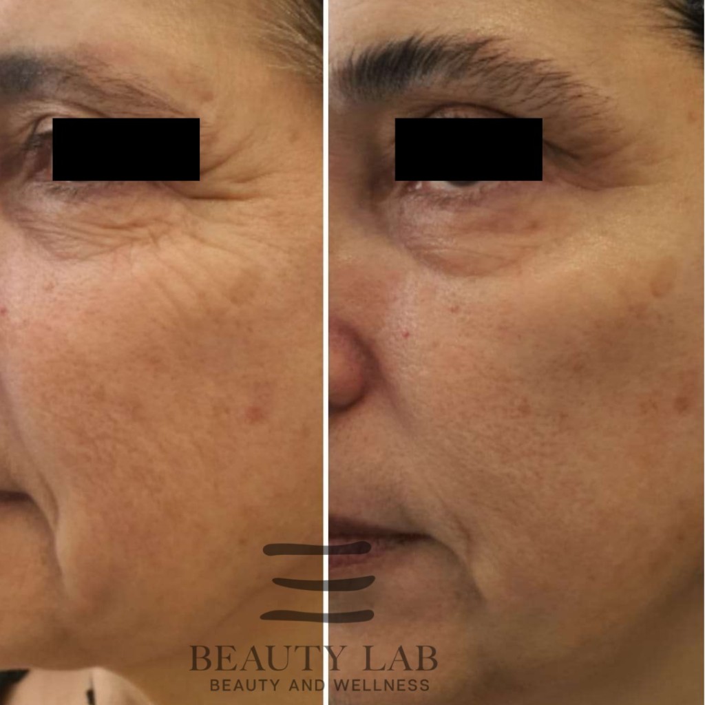 Risultato Skin Perfect 6
