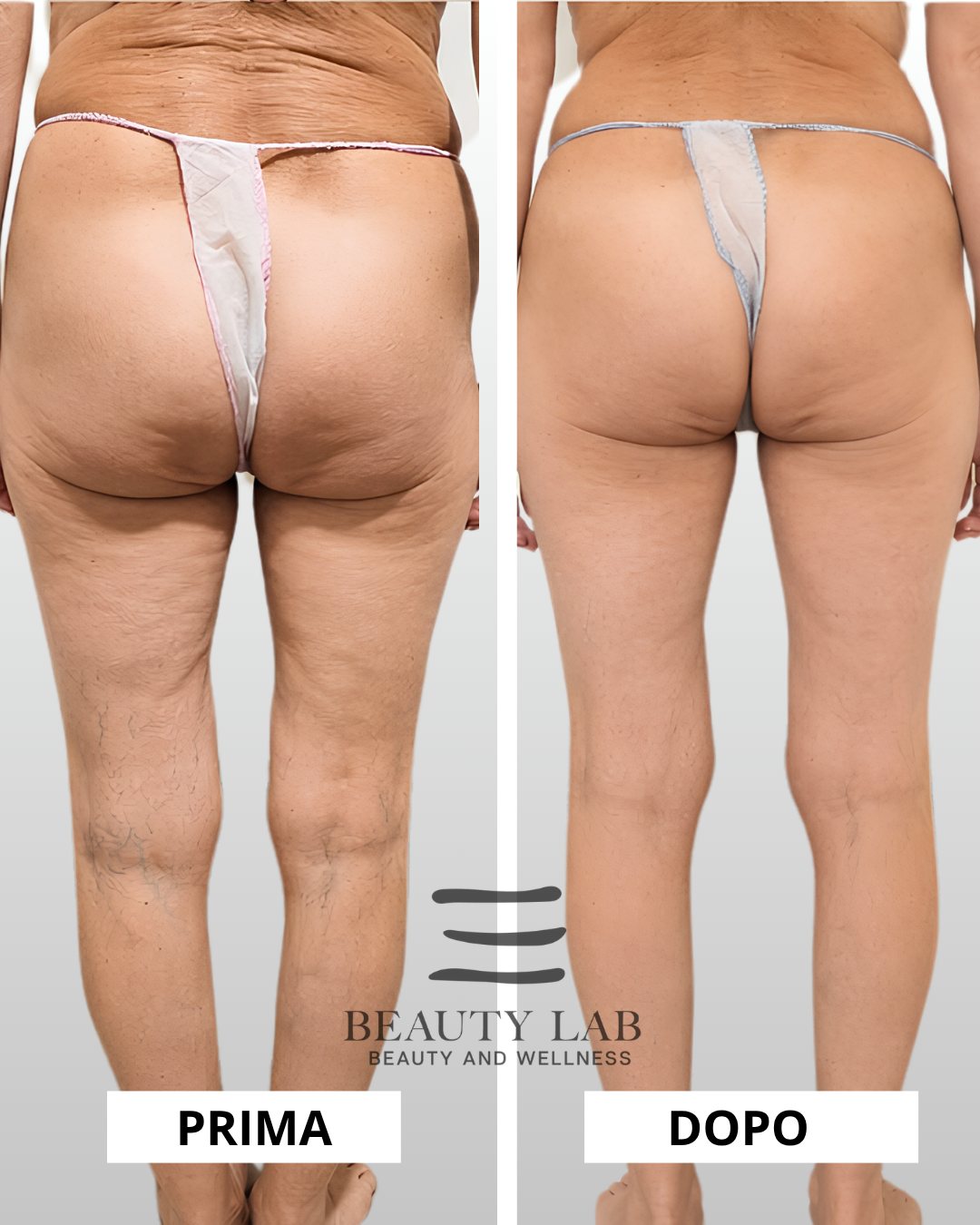 Prima e dopo Body Regenesis a Pescara: addome, fianchi e gambe rimodellate