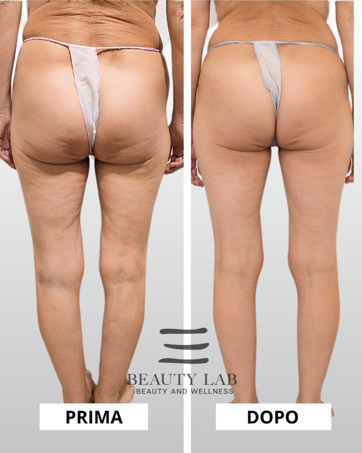 Prima e dopo Body Regenesis a Pescara: cellulite ridotta e texture pelle migliorata
