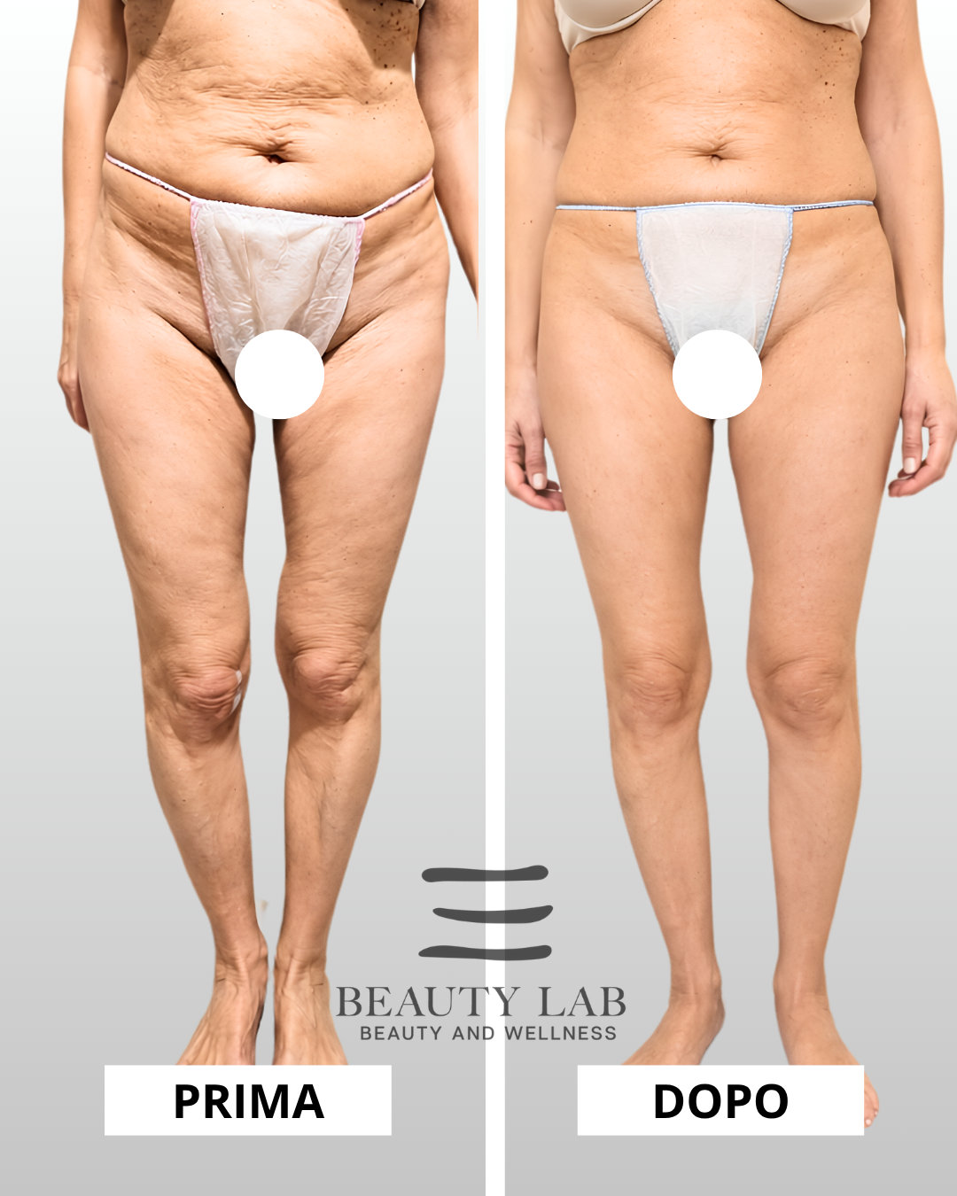 Prima e dopo Body Regenesis a Pescara: addome e cosce, silhouette definita