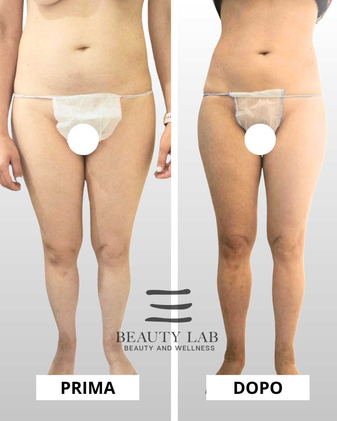 Prima e dopo Body Regenesis a Pescara: addome e cosce, silhouette definita