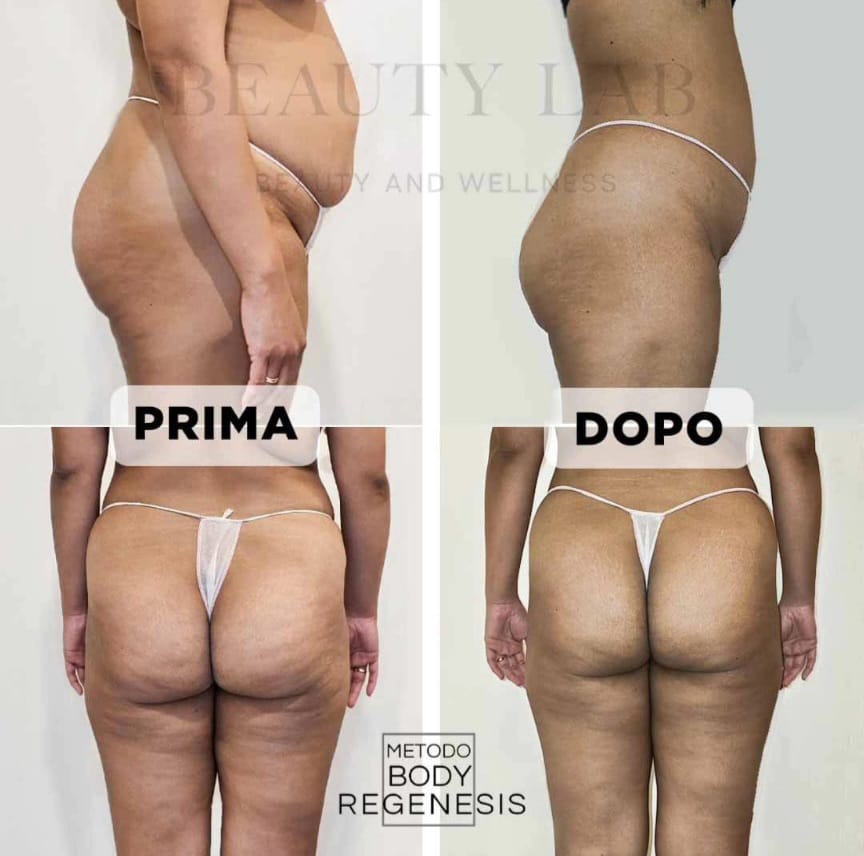 Prima e dopo Body Regenesis a Pescara: glutei, fianchi e compattezza della pelle