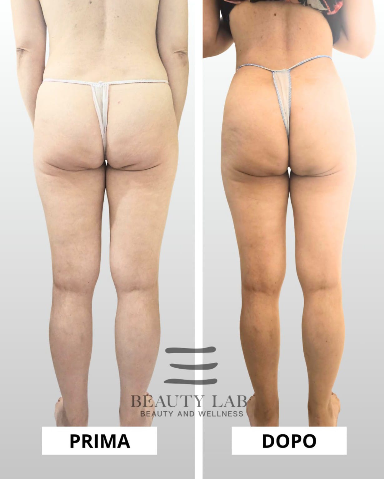 Prima e dopo Body Regenesis a Pescara: glutei e silhouette laterale rimodellati