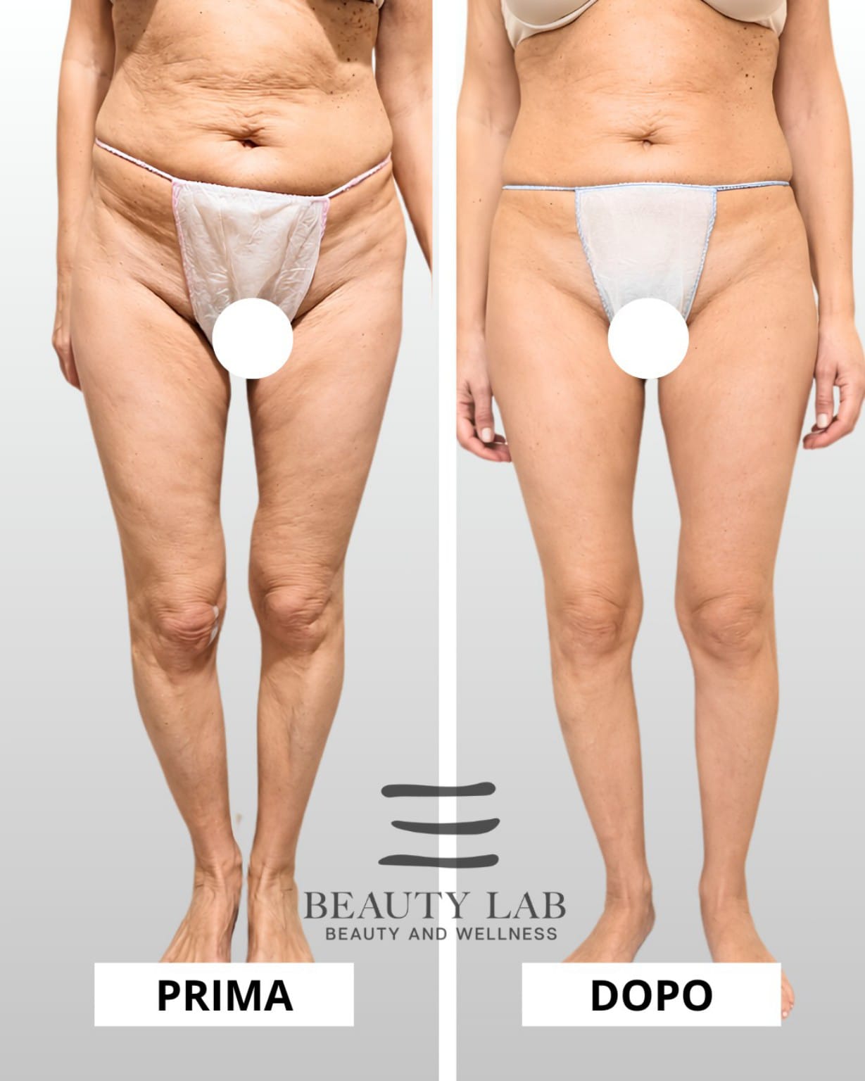 Prima e dopo Body Regenesis a Pescara: addome e cosce, silhouette definita