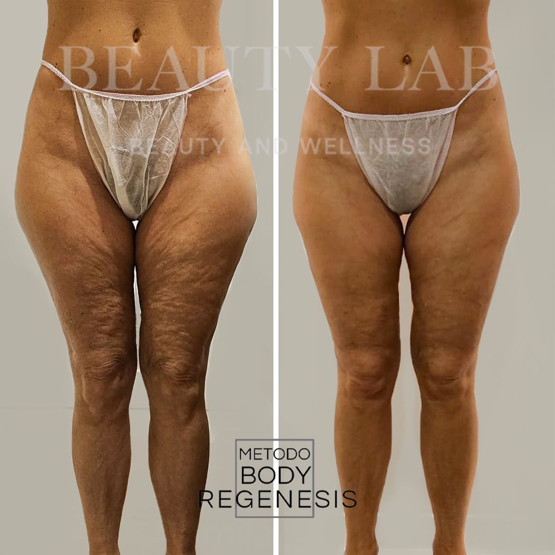 Prima e dopo Body Regenesis a Pescara: glutei e silhouette laterale rimodellati