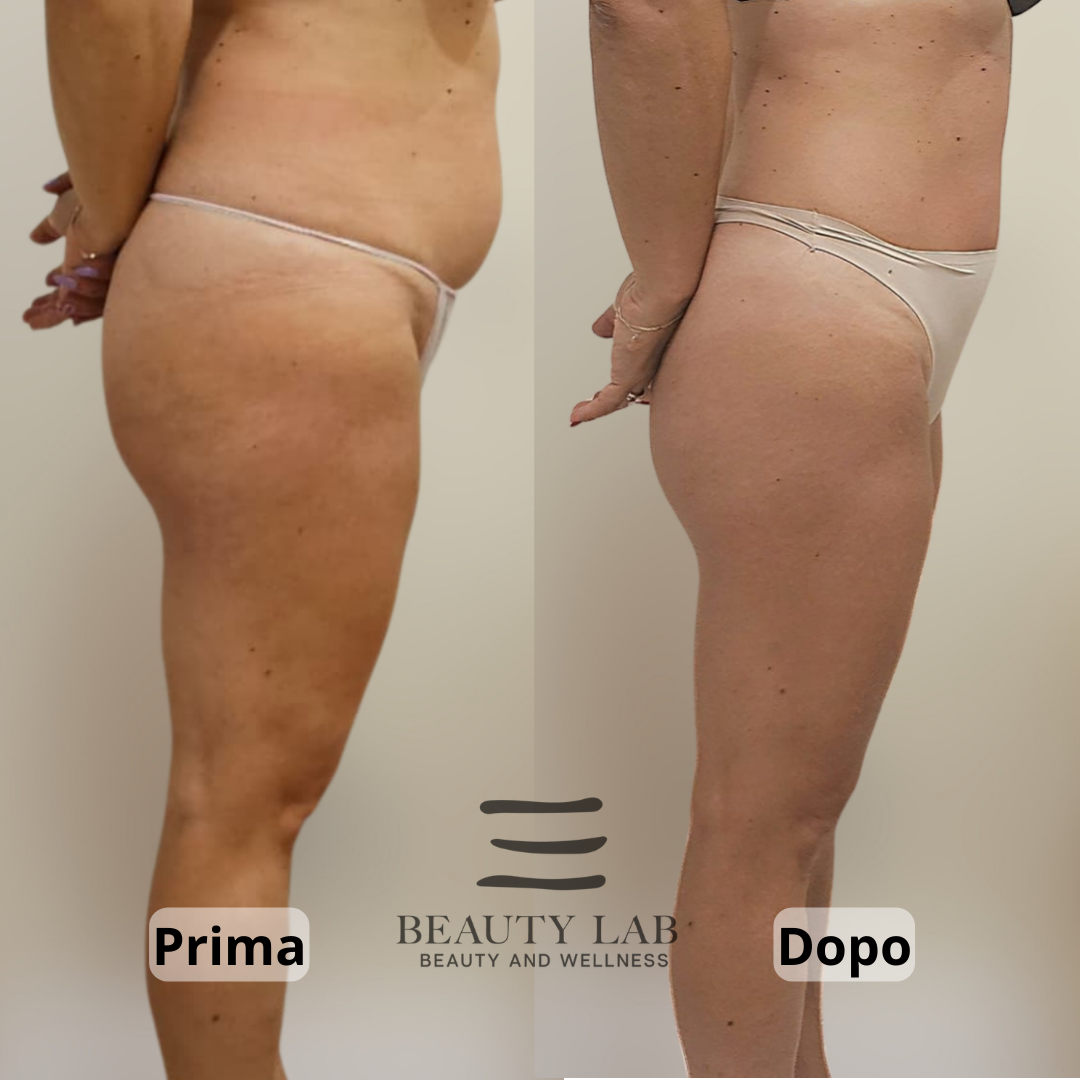 Prima e dopo Body Regenesis a Pescara: glutei, fianchi e compattezza della pelle