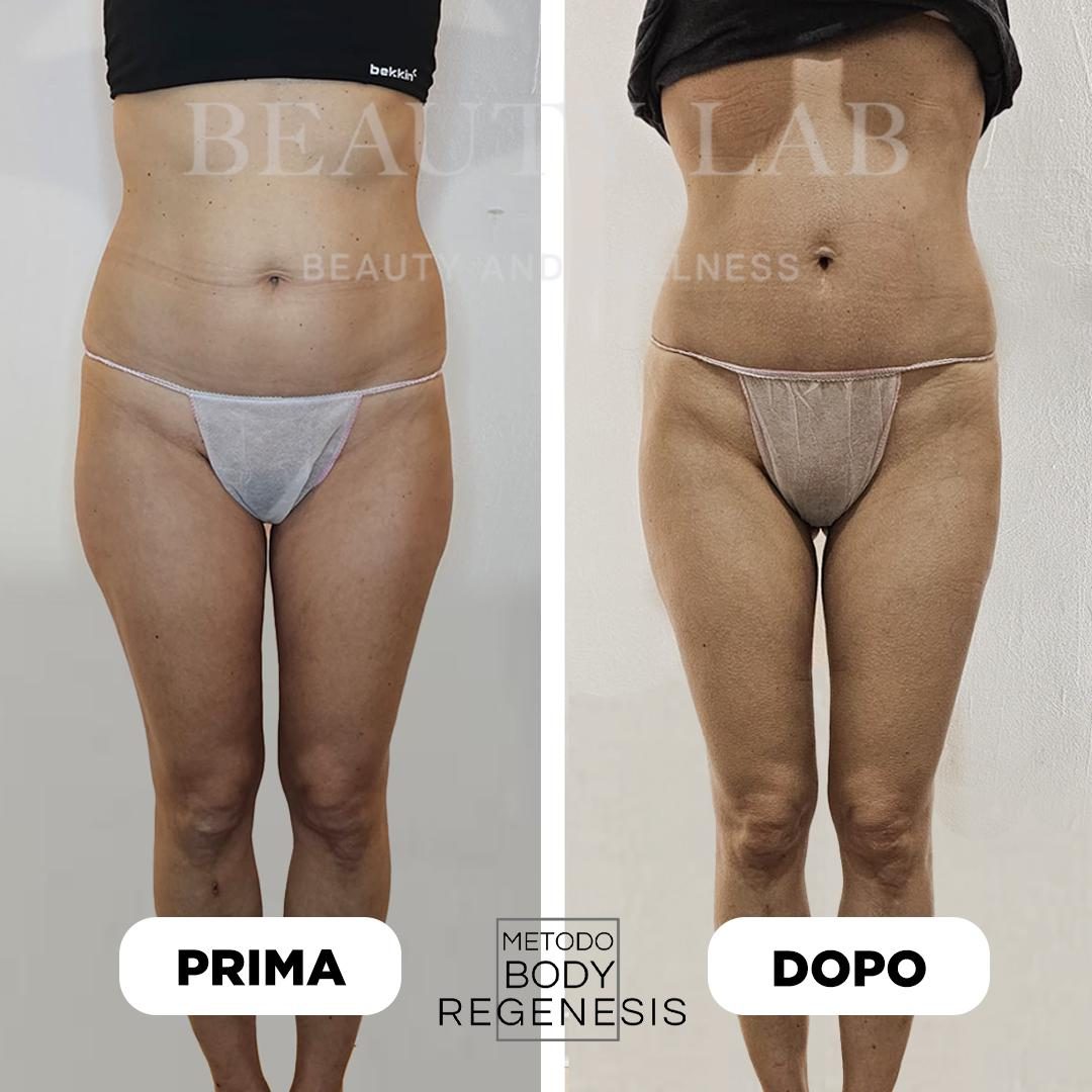 Prima e dopo Body Regenesis a Pescara: glutei e silhouette laterale rimodellati