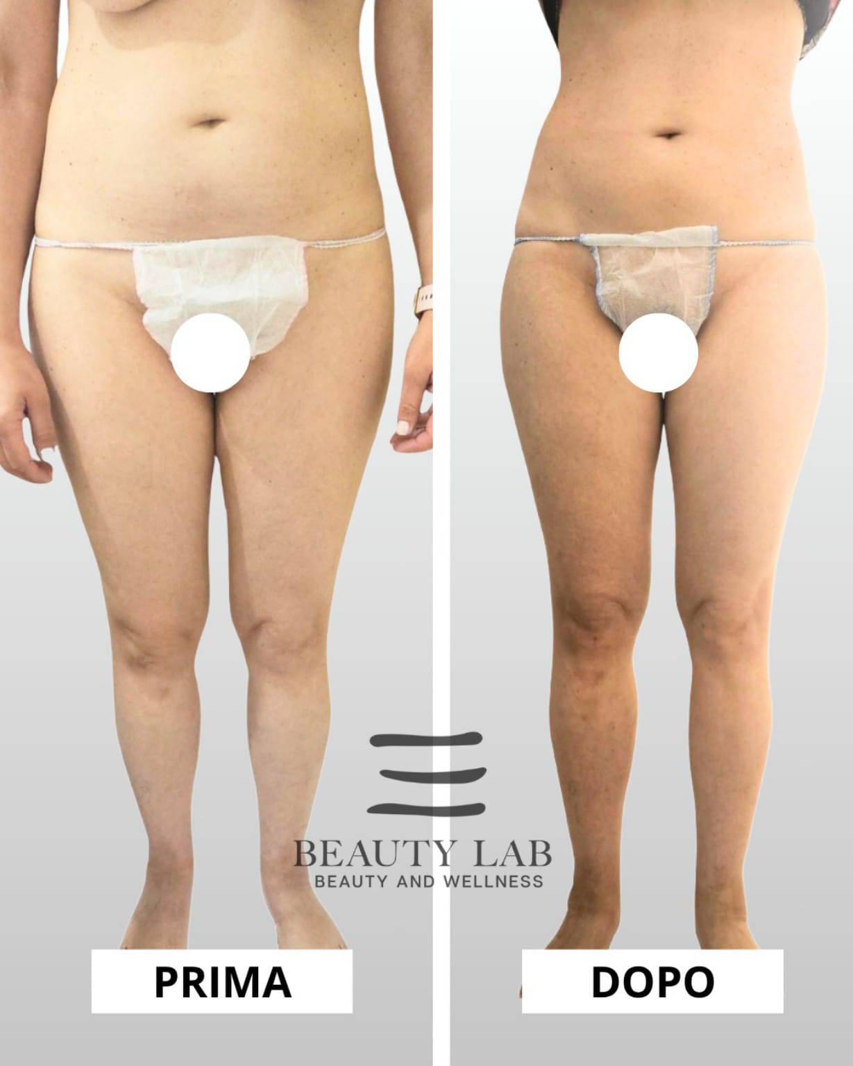 Prima e dopo Body Regenesis a Pescara: gambe e glutei più tonici