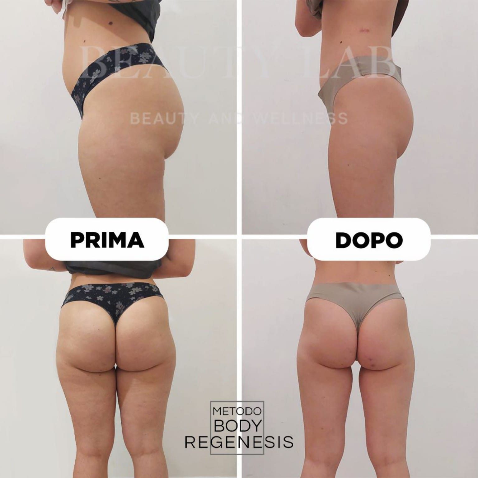 Prima e dopo Body Regenesis a Pescara: riduzione adiposità localizzate e silhouette