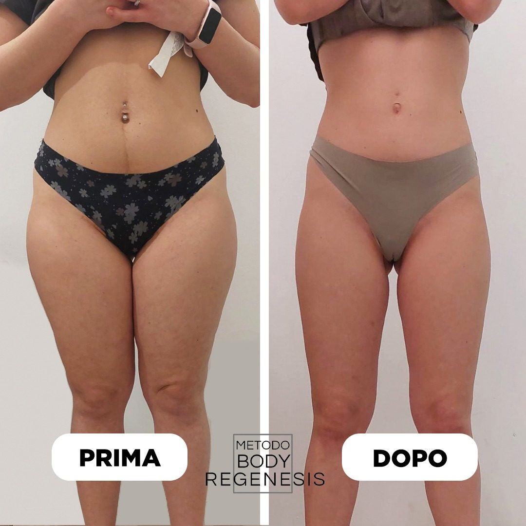 Prima e dopo Body Regenesis a Pescara: riduzione adiposità localizzate e silhouette