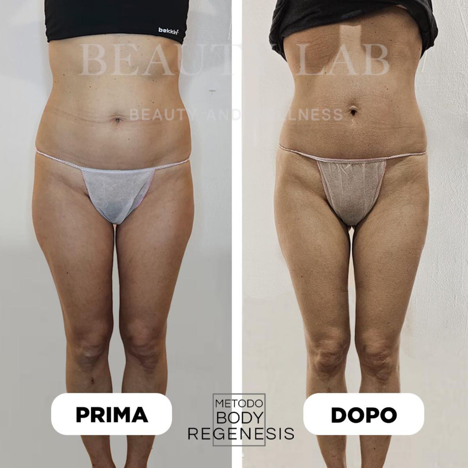Prima e dopo Body Regenesis a Pescara: addome, fianchi e gambe rimodellate